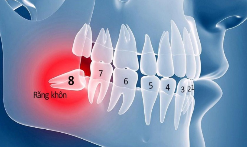 Răng khôn mọc ngầm, mọc lệch Răng khôn mọc ngầm, mọc lệch