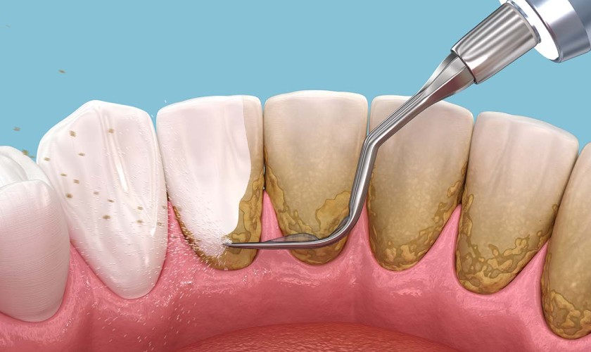 Cạo vôi răng điều trị sưng lợi hàm trên Cạo vôi răng điều trị sưng lợi hàm trên