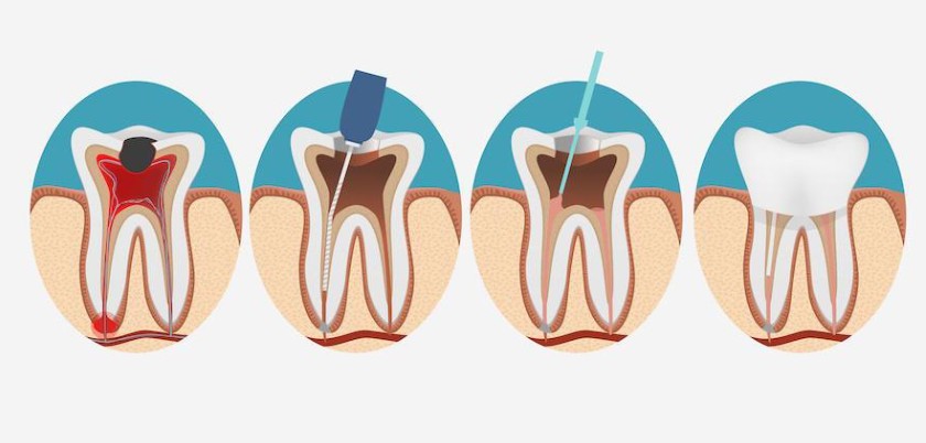Lấy tủy răng điều trị viêm tủy Lấy tủy răng điều trị viêm tủy