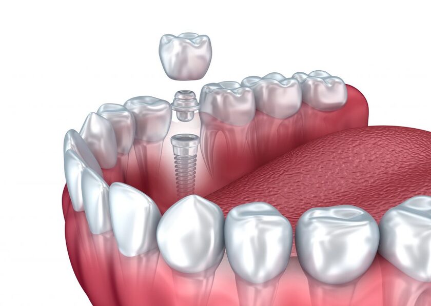Bạn nên tham khảo ý kiến của bác sĩ để chọn loại implant phù hợp
