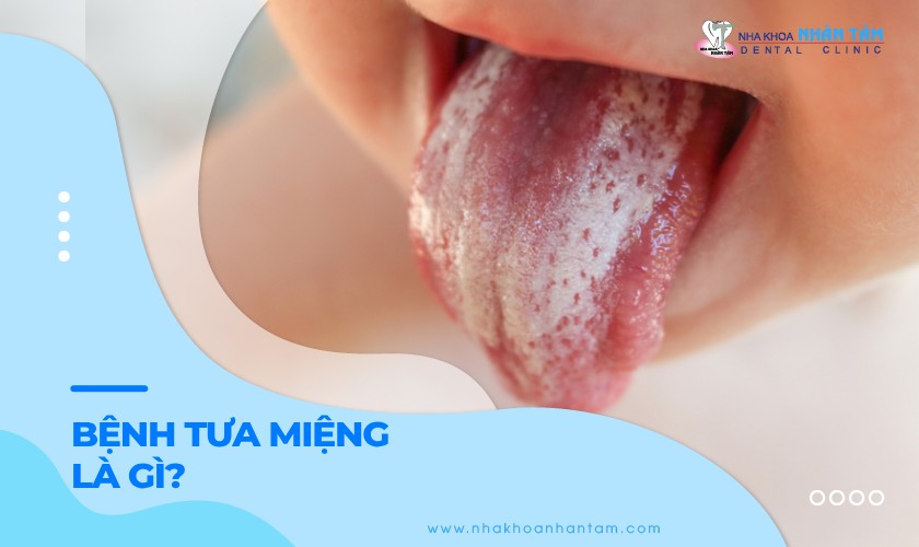 Tưa miệng là gì? Làm thế nào để ngăn ngừa và điều trị