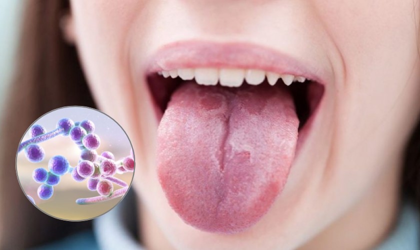 Bệnh tưa miệng do nấm Candida gây nên