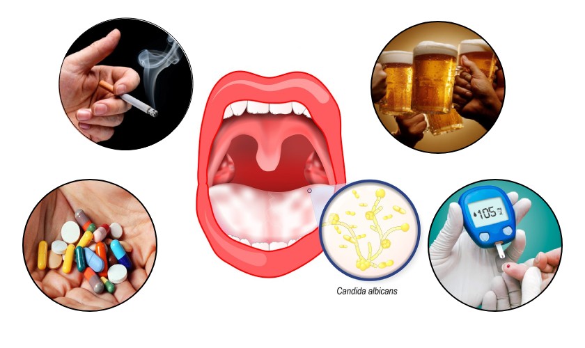 Những nguyên nhân phổ biến gây bệnh tưa miệng