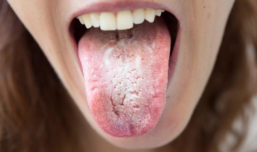 Với người khỏe mạnh, tưa lưỡi có thể để khắc phục bằng cách sử dụng thuốc theo chỉ định của bác sĩ