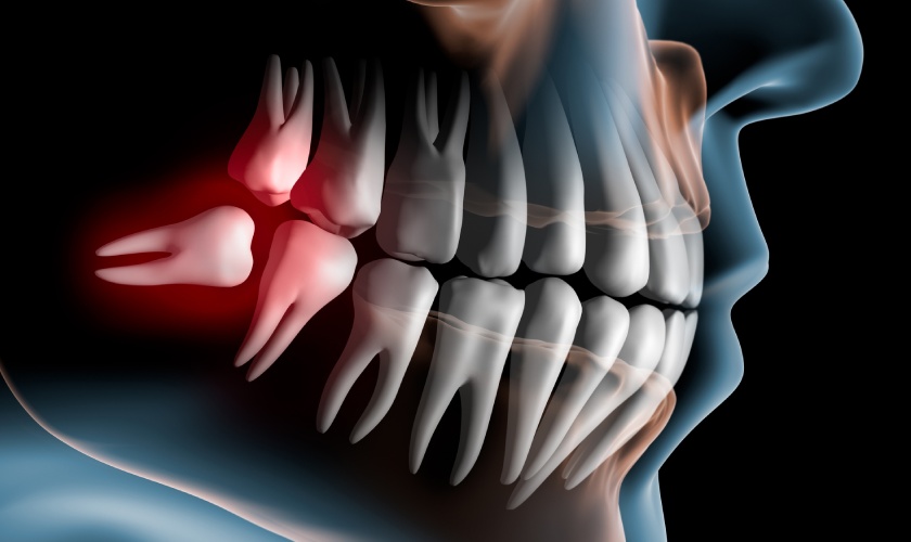 Răng khôn thường được bác sĩ chỉ định nhổ