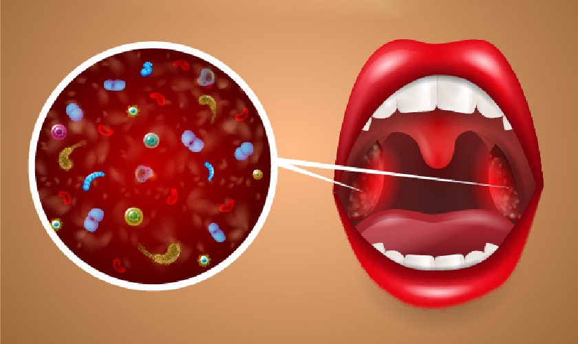 Đau họng kèm theo sốt cao liên tục là dấu hiệu của viêm họng cấp do virus gây ra