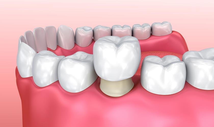 Bọc răng sứ giúp khôi phục hoàn hảo cả thẩm mỹ lẫn chức năng của răng