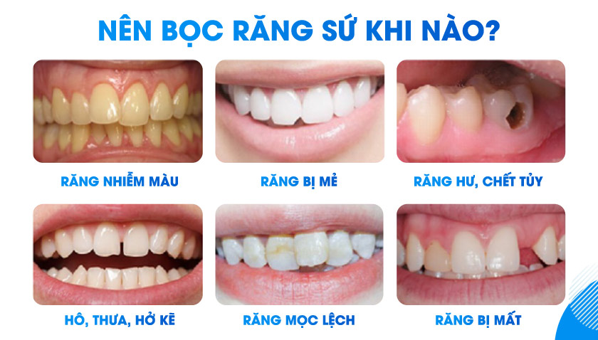 Nên làm răng sứ trong trường hợp nào?