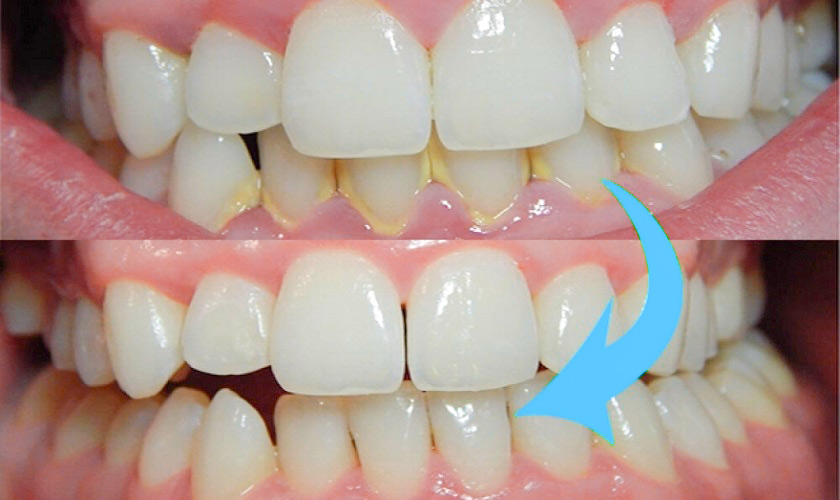 Lấy cao răng giúp răng trắng sáng và khỏe mạnh hơn