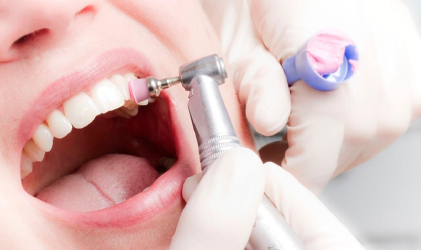 Đánh bóng răng sau khi cạo vôi răng