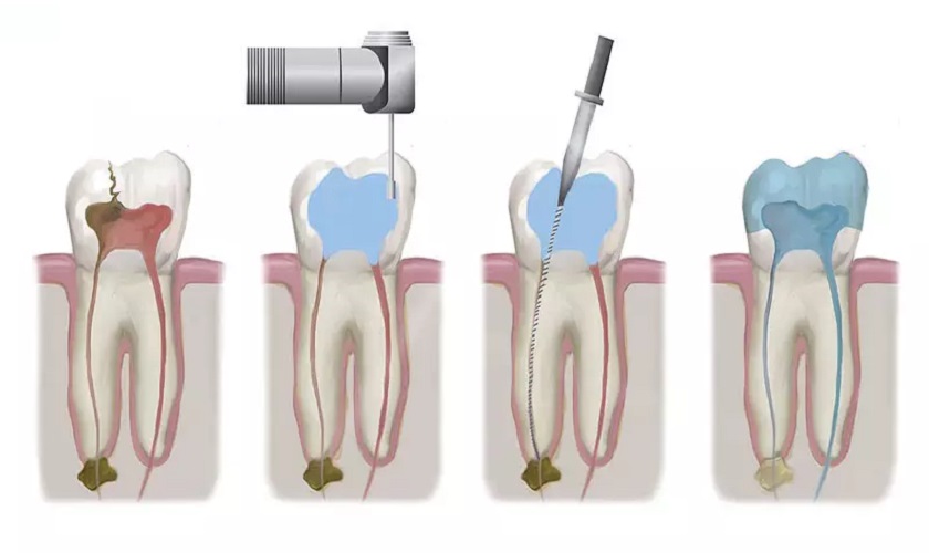 Các bước trong quá trình điều trị tủy răng