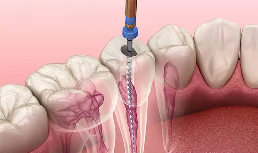 Khi nào nên thực hiện thủ thuật lấy tủy răng?
