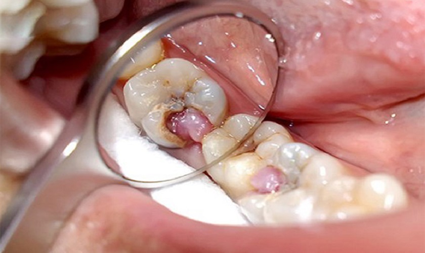 Hiện tượng viêm tủy răng mạn tính