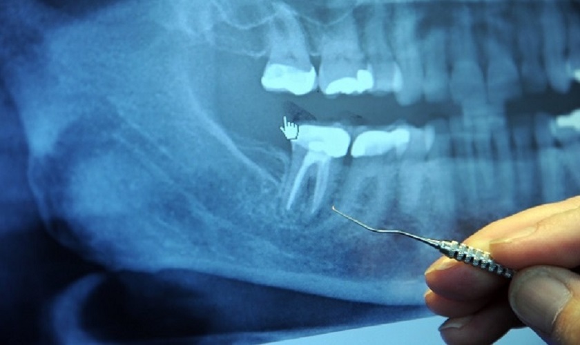 Chụp X – quang để đánh giá tình trạng răng trước khi điều trị