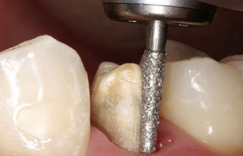 Mài răng không chuẩn là nguyên nhân khiến bọc răng sứ bị ê buốt