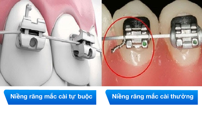 Niềng răng mắc cài tự buộc và mắc cài thường