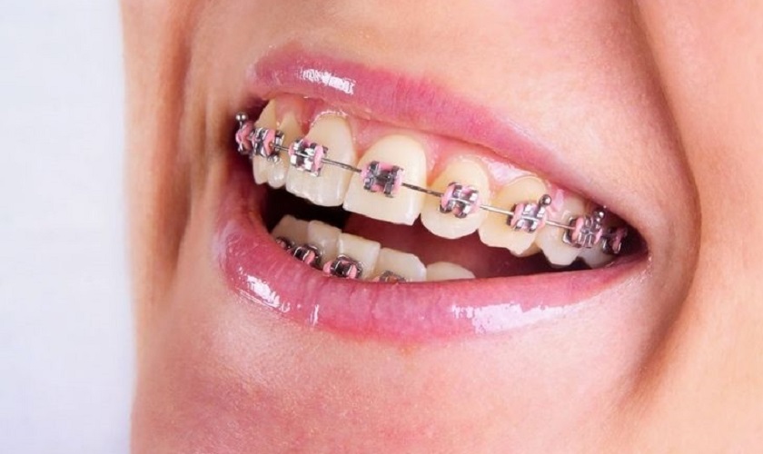 Niềng răng mắc cài truyền thống