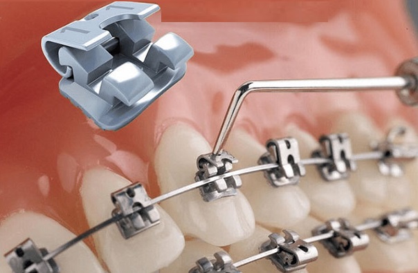 Niềng răng mắc cài tự khóa được cải tiến và đem lại nhiều ưu điểm hơn