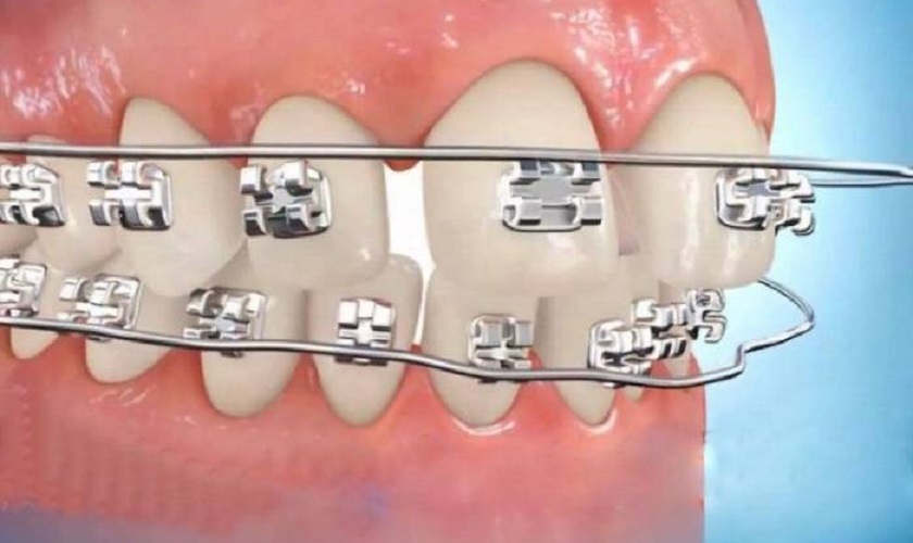 Sử dụng mắc cài thường dây cung có thể bị tuột khi ăn uống do chun buộc không ổn định