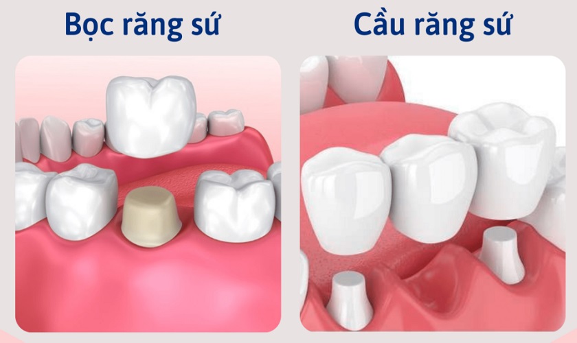 Kỹ thuật bọc răng sứ thẩm mỹ và làm cầu răng sứ phục hình răng mất