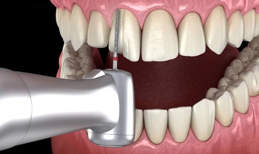 Mài răng bọc sứ có gây ảnh hưởng xấu tới sức khỏe không?