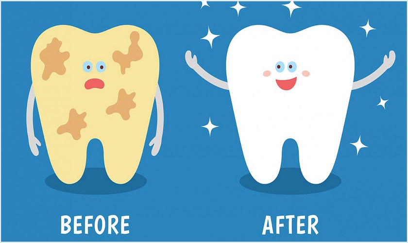 Yếu tố nào có thể làm tăng nguy cơ răng bị mảng bám đen?