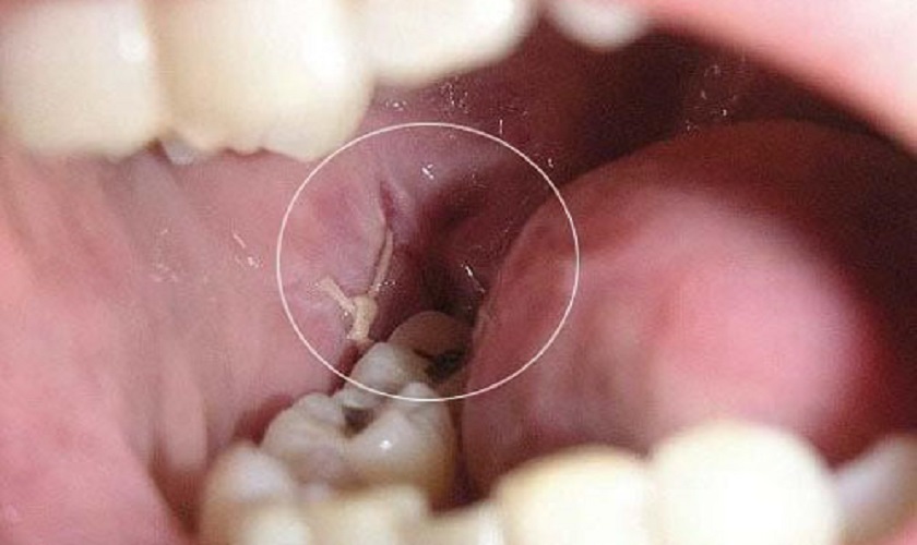 What is the cause of the white membrane after wisdom tooth extraction?