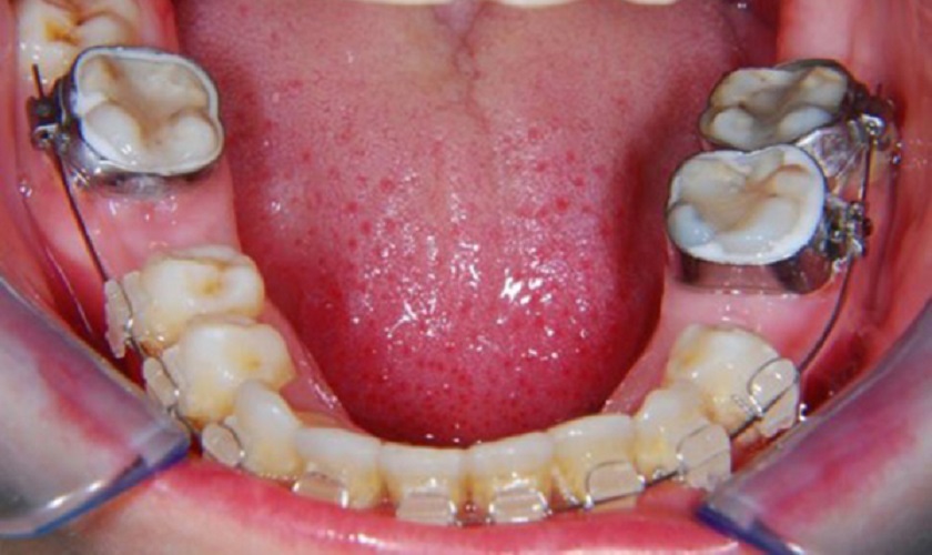 Sử dụng khí cụ định hình trong chỉnh nha cho người mất răng