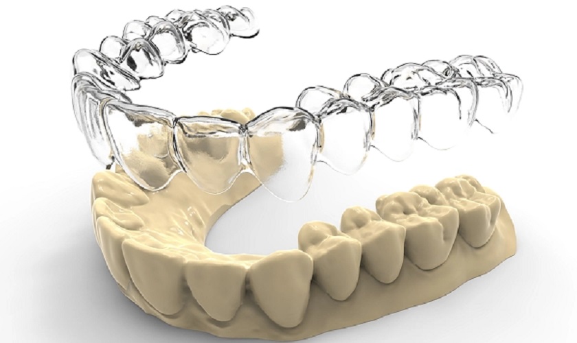 Kỹ thuật niềng răng trong suốt Invisalign