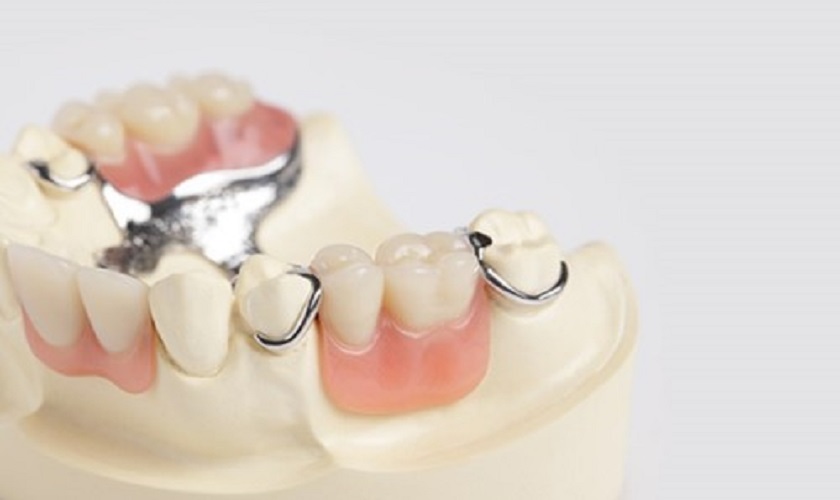 Răng giả tháo lắp vẫn được sử dụng để phục hình răng mất