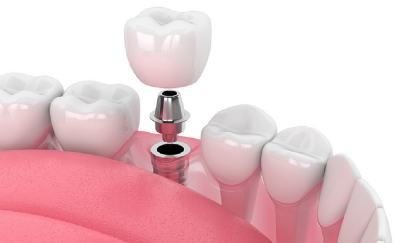 Trồng răng Implant – giải pháp tối ưu nhất để phục hình răng mất