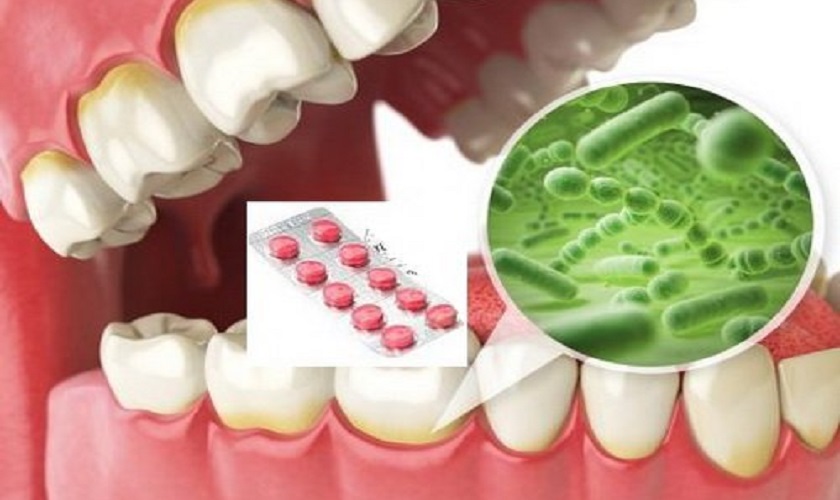 Thuốc kháng sinh có thể được sử dụng để điều trị viêm chân răng<