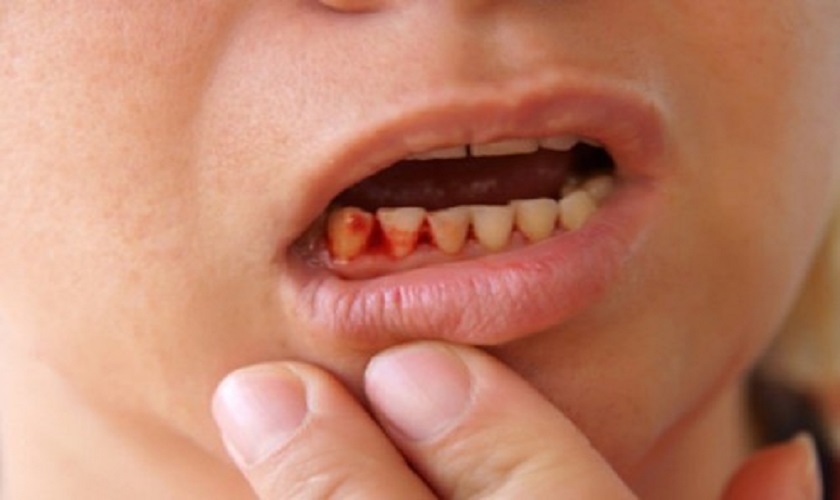 Nằm mơ tự nhổ răng có chảy máu - tốt hay xấu?