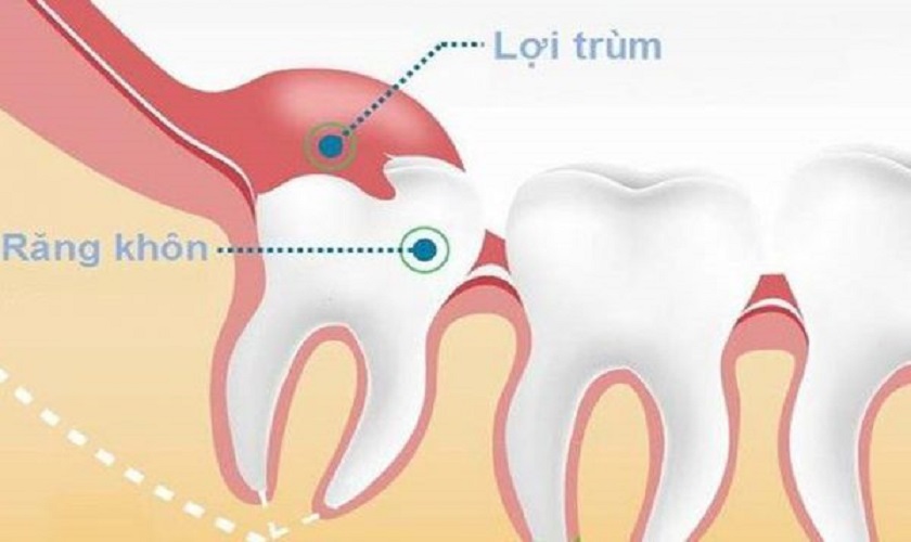 Cắt lợi trùm răng khôn có thể được chỉ định nếu răng khôn mọc thẳng Cắt lợi trùm răng khôn có thể được chỉ định nếu răng khôn mọc thẳng