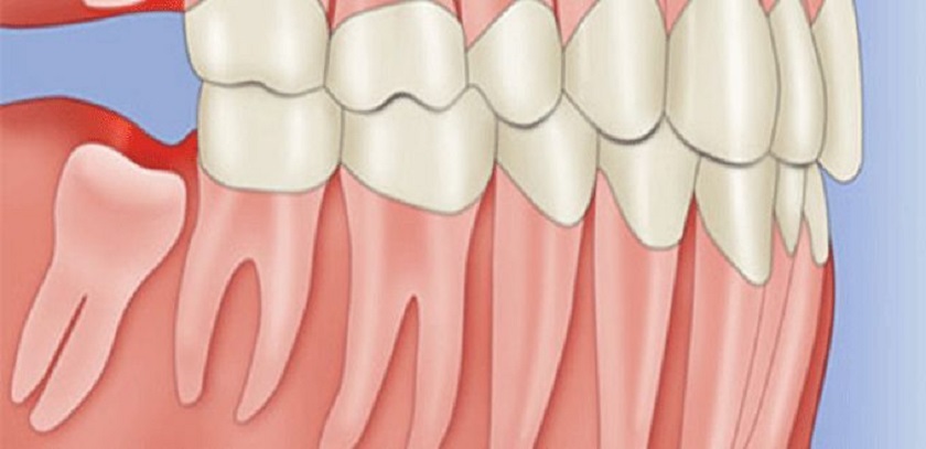 Mọc răng khôn là điềm báo may mắn theo quan niệm tử vi