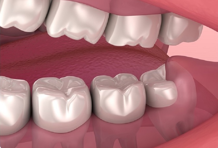 Bạn là người rất may mắn nếu có răng khôn mọc thẳng