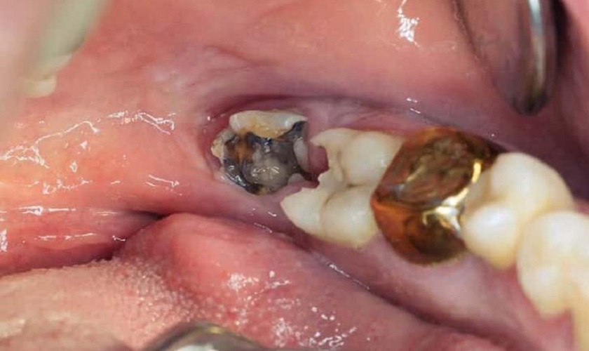 Nên nhổ răng khôn khi chúng bị sâu