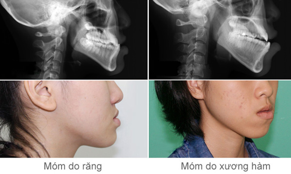 Móm có thể xảy ra do xương hoặc do răng