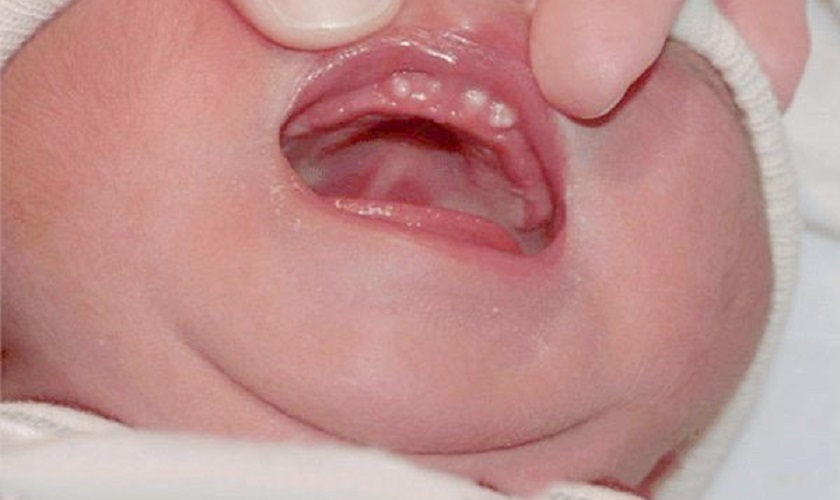 Nanh sữa ở trẻ sơ sinh – Dấu hiệu, nguyên nhân và cách xử lý