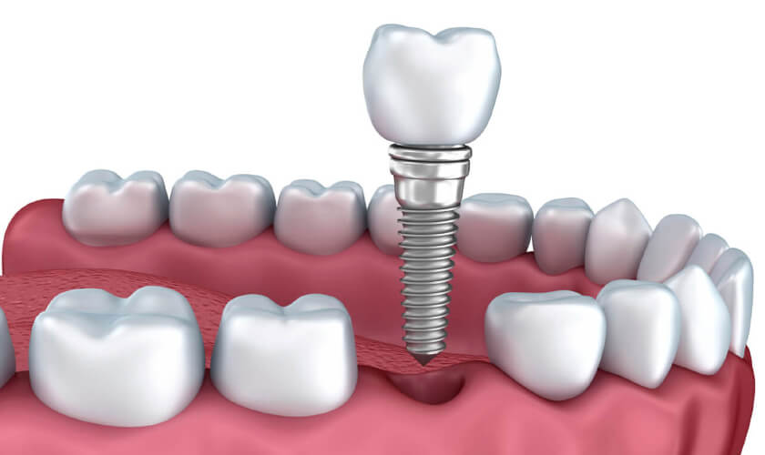 Phương pháp trồng răng Implant