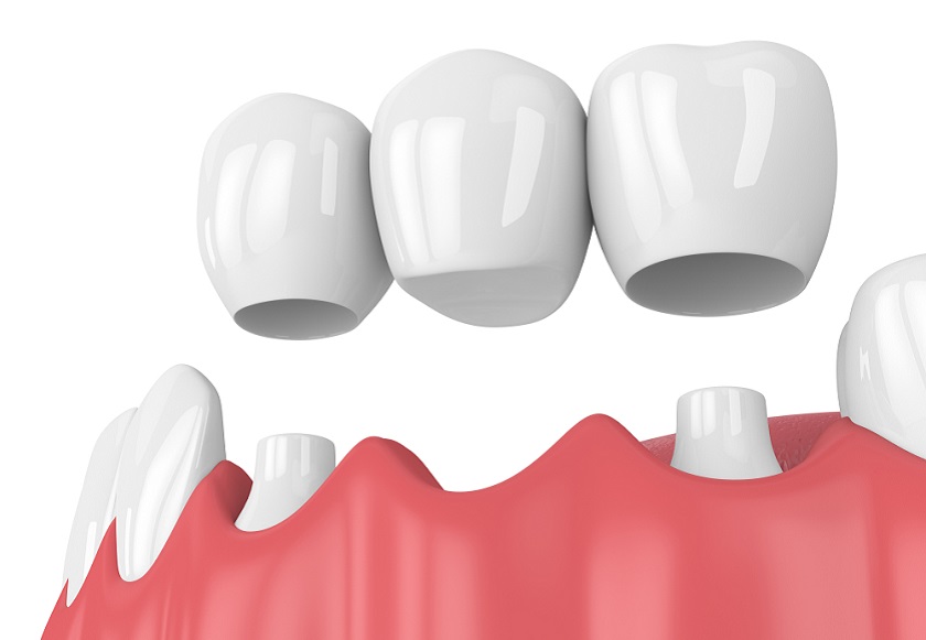 Kỹ thuật làm cầu răng sứ