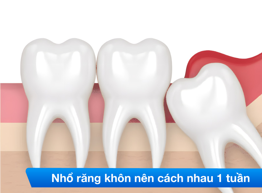 Nhổ răng khôn nên cách nhau khoảng 1 tuần