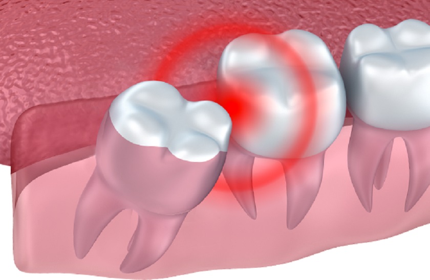 Răng khôn có nguy cơ mọc lệch cao do không đủ diện tích trống trên cung hàm