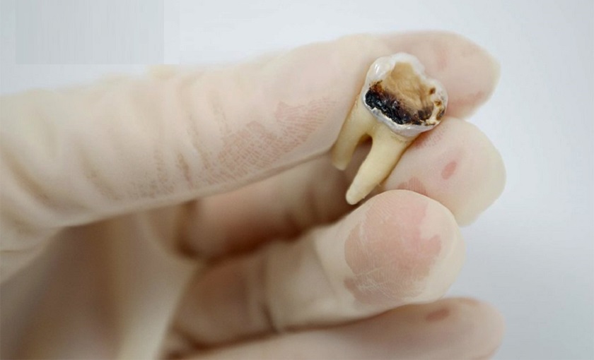 Cần tiến hành loại bỏ khi răng khôn bị sâu