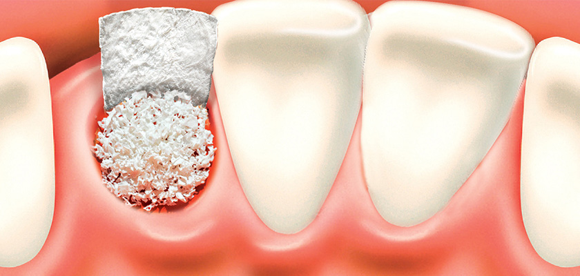 Quy trình ghép xương ổ răng trong Implant sẽ trải qua 5 bước cơ bản