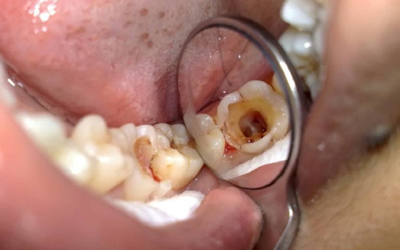 20 Hình ảnh sâu răng tại các vị trí và giai đoạn sâu răng