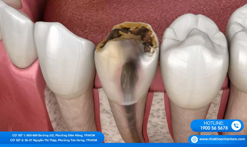 Hình: Arsenic trioxide từng được sử dụng để “diệt tủy răng”