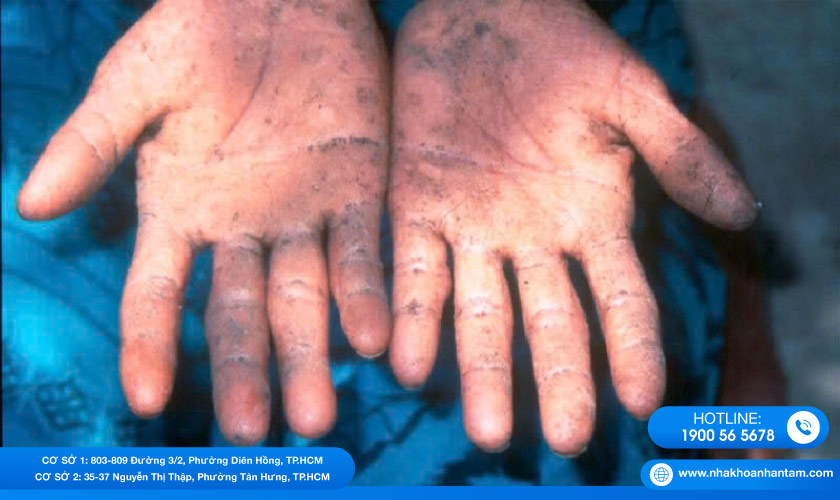 Hình: Thạch tín có thể gây hoại tử xương ổ răng, viêm da, gây tổn thương gan, phổi, da, hệ thần kinh