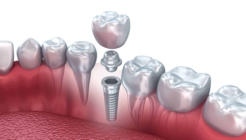 Cấu trúc phục hình răng trên implant