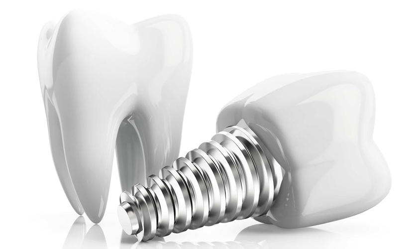 Cấu tạo răng Implant Cấu tạo răng Implant gồm trụ Titanium, Abutment và mão sứ